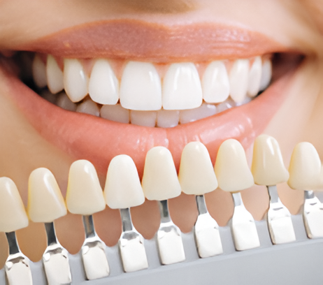 Λεύκανση δοντιών Περισσός | επαγγελματική λεύκανση